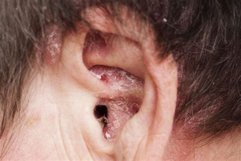 Managing Psoriasis Behind the Ear: Tips for Relief and Prevention ...