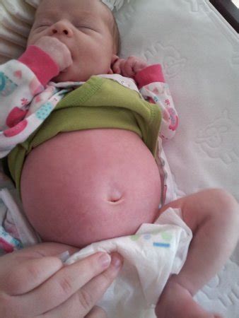 bloated belly *pic* - BabyCenter