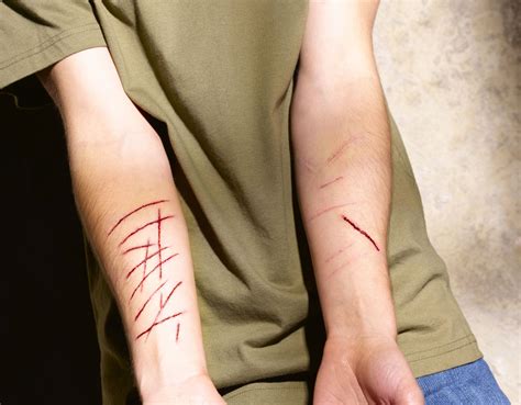 Cutting and Other Forms of PTSD Self-Mutilation