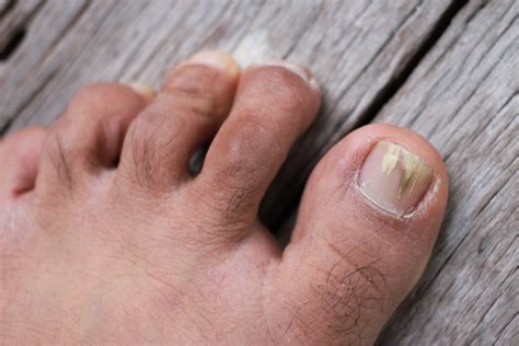 Fungal Toenail Polish