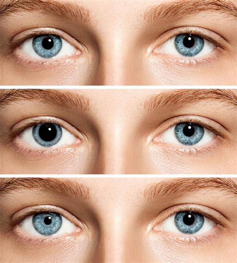 Anisocoria: Why is one pupil larger than the other? - Sistina Ophthalmology