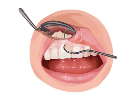 What is scaling and root planing? | Authority Dental