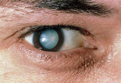 The Disease Of Eye Cataracts