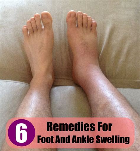 Easy Home Remedies For Foot And Ankle Swelling | Foot, ankle swelling, Swollen ankles, Foot remedies