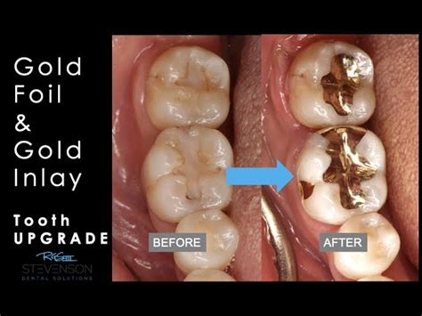 Gold Dental Fillings