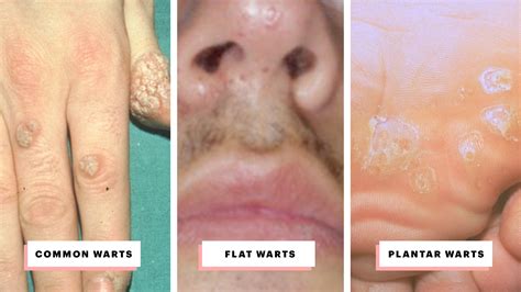 Hpv Warts On Lips Treatment | Lipstutorial.org