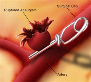 Brain Aneurysm Repair Surgery