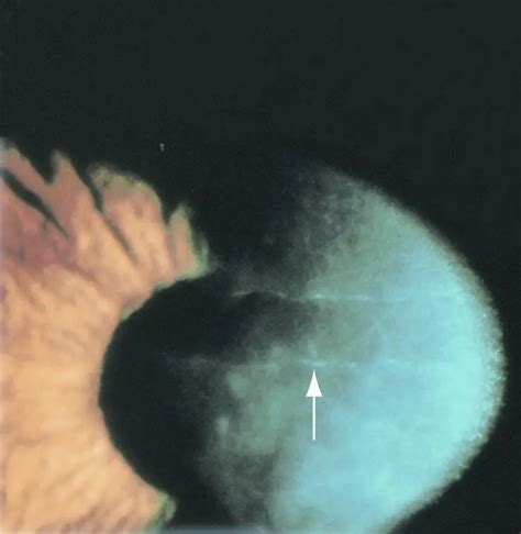 Posterior polymorphous dystrophy - American Academy of Ophthalmology