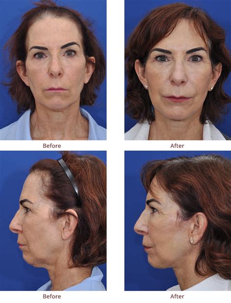 LIFE Before and After Photos | Mini-Facelift