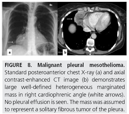 Diagnostic imaging and workup of malignant pleural mesothelioma