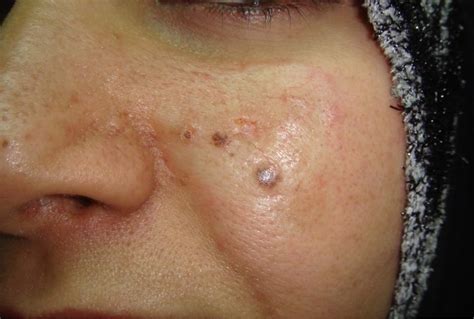 Basal Cell Carcinoma - Causes, Types, Symptoms, Prognosis, Treatment