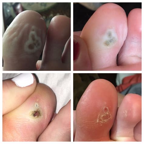 Stages Of Plantar Wart Removal Using Salicylic Acid | Bruin Blog