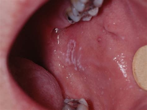 Oral Lichen Planus - Causes, Symptoms, Prognosis, Diagnosis, Treatment