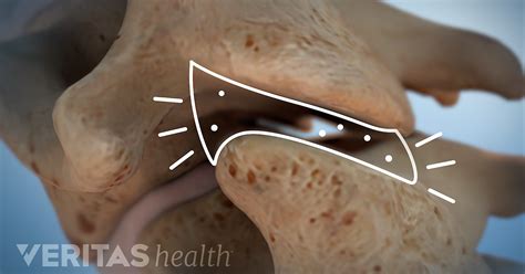 What Is Crepitus?