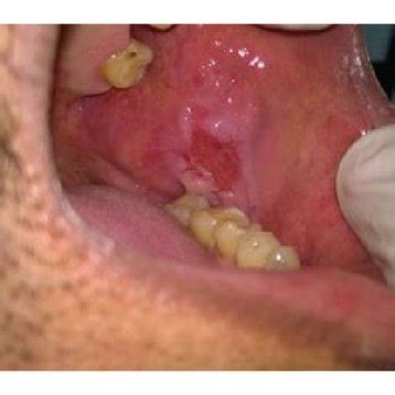 Ulcer on the left buccal mucosa, ovoid in shape. | Download Scientific ...