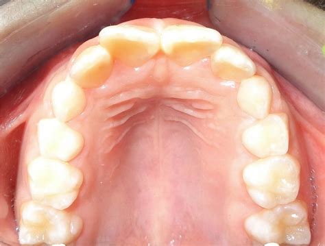 Occlusal photo showing palatal rugae. | Download Scientific Diagram