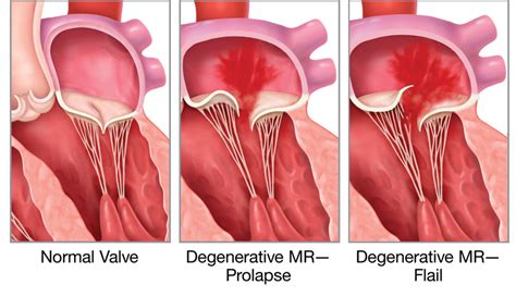 Mitral Valve Disease: Types, Causes, and Symptoms - Apollo Hospitals