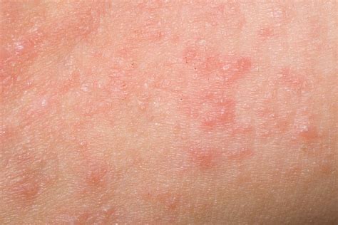 Scabies Rash Look Like And Causes15 | Images and Photos finder