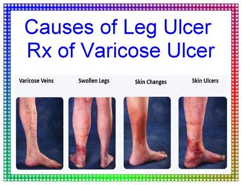 Causes of leg ulcer Rx of varicose ulcer in 2020 | Leg ulcers, Varicose ulcer, Ulcers