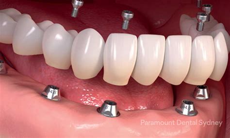 Dental Implants Sydney - Replace Missing Teeth | Paramount Dental — Paramount Dental Sydney