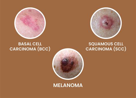 3 Types Of Skin Cancer – NBKomputer