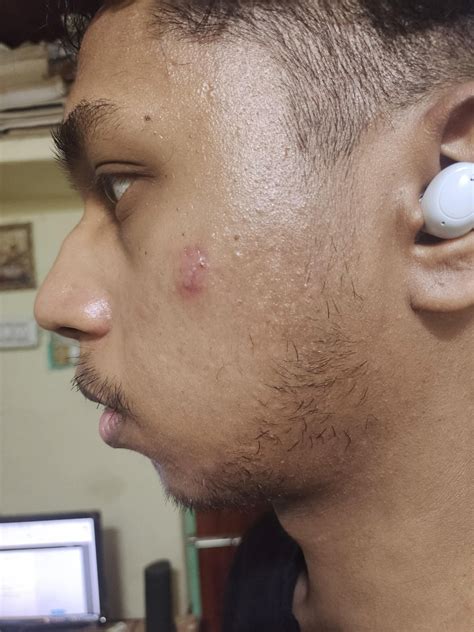 Should I take accutane : r/acne