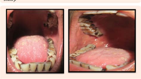 Diagnosis and Management of Pseudomembranous Candidiasis | Semantic Scholar