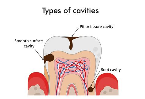 Types of cavities - Complete Smile Dental