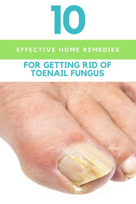 10 Effective Home Remedies For Getting Rid Of Toenail Fungus