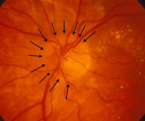 Papilledema Grading