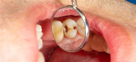 Five Stages of Tooth Decay | Mint Hill Dentistry