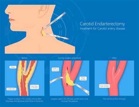 Carotid Revascularization | Brown Surgical Associates