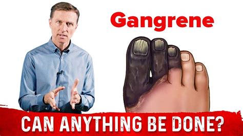 Why Do Some Diabetics Get Gangrene? - YouTube | Doctor of chiropractic, Fun to be one, Diabetes