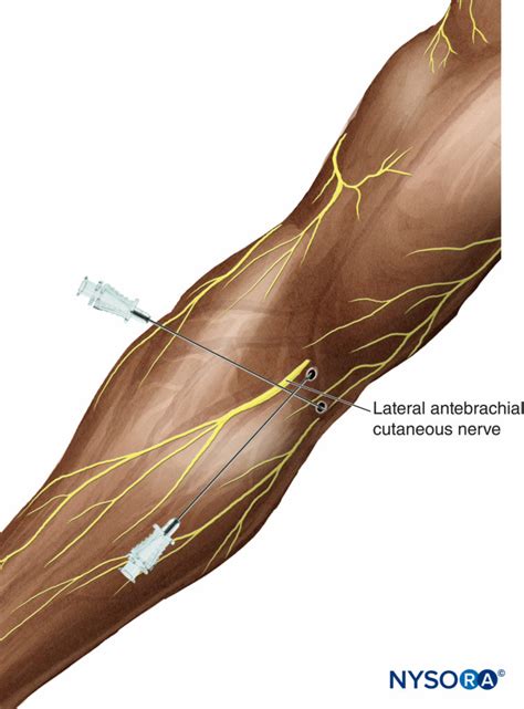 regional-anesthesia-blocks-of-the-lateral-and-medial-antebrachial-cutaneous-nerve - NYSORA