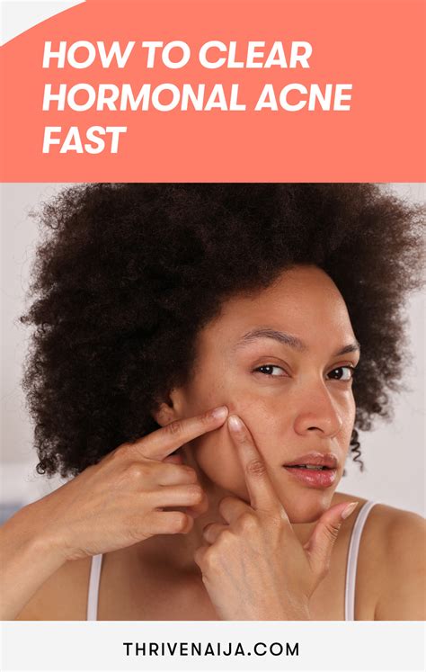 How to Clear Hormonal Acne Fast: Complete Guide | ThriveNaija