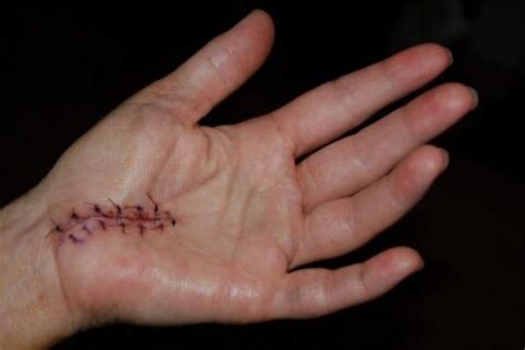 I Had Carpal Tunnel Surgery - Here Is What I've Learned | Healthy Living Guide