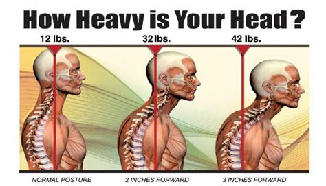 Forward Head Posture (FHP) Is A Condition That Can Be Cured