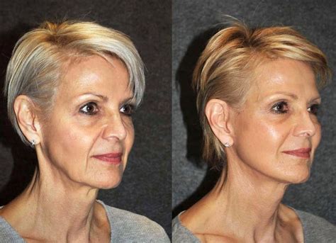 Deep Plane Facelift Before & After - Dr. Andrew Jacono | Face lift surgery, Face makeover, Face ...