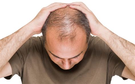 What causes male pattern baldness - superliving