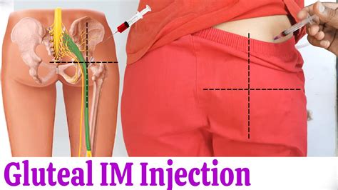 How to give IM (Intramuscular) injection in buttock or hip easily at ...