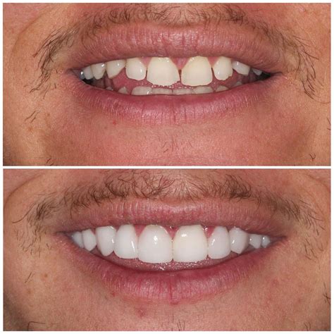 Teeth Veneers Before And After