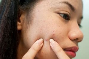 Bad Skin – Main Causes And Tips To Combat Them