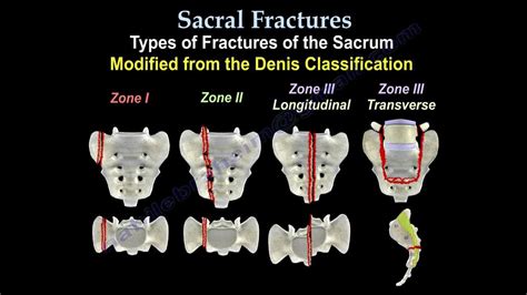 Sacral Fractures – Core EM