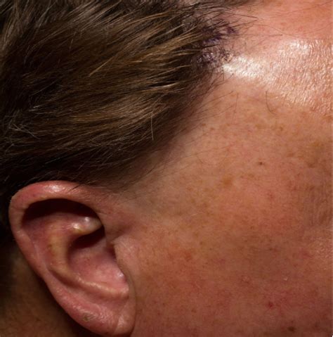 Frontal Fibrosing Alopecia: Causes, Symptoms & Treatments