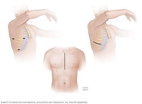 Tricuspid valve repair and tricuspid valve replacement - Mayo Clinic