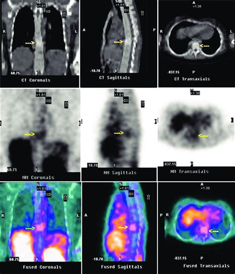 Technetium-99m-ethambutol scintigraphy diagnostic image of 27-year-old... | Download Scientific ...