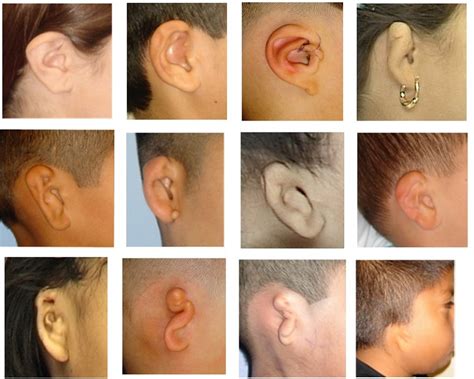 Microtia Ear Surgery and Bone Anchored Hearing Devices Sheryl Lewin ...