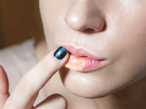 Split Lip: Treatment, Causes, Vitamin Deficiency, and Infection