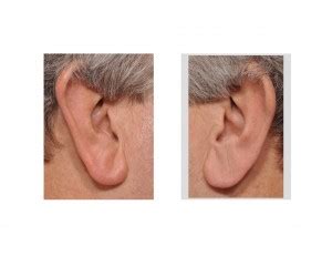 Case Study: Reduction of Large Earlobes - Explore Plastic Surgery