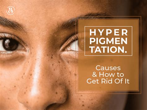 Hyperpigmentation: Causes and How to Get Rid Of It - BeauCrest